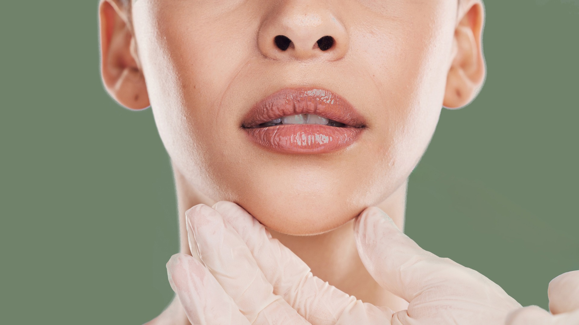 Πόσο διαρκεί η χρήση υαλουρονικού οξέος στα χείλη;